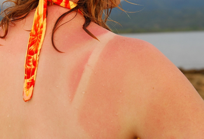 skin cancer3