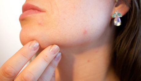 5 zasad skutecznej pielęgnacji skóry trądzikowej